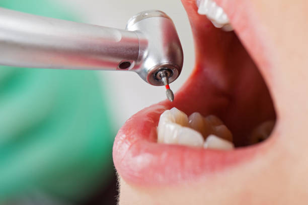 Best Emergency Root Canal Treatment in Rosedale, MS